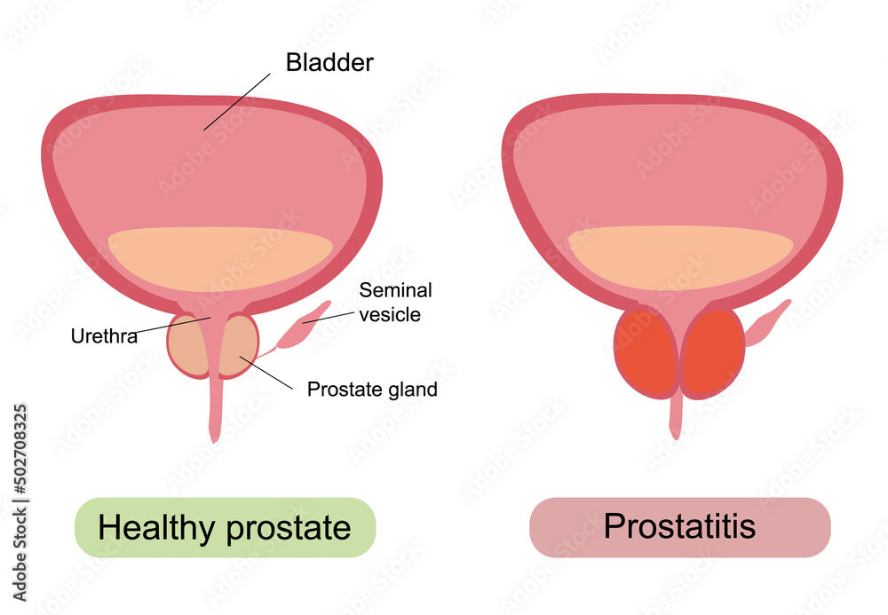 Prostate Health